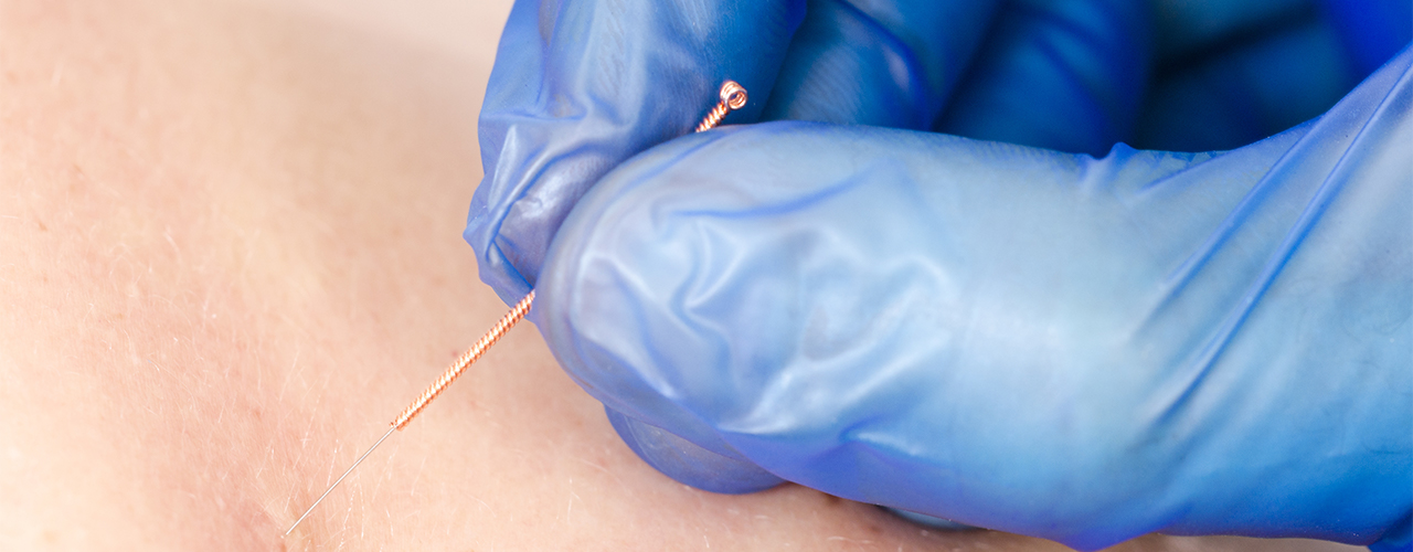 Dry Needling